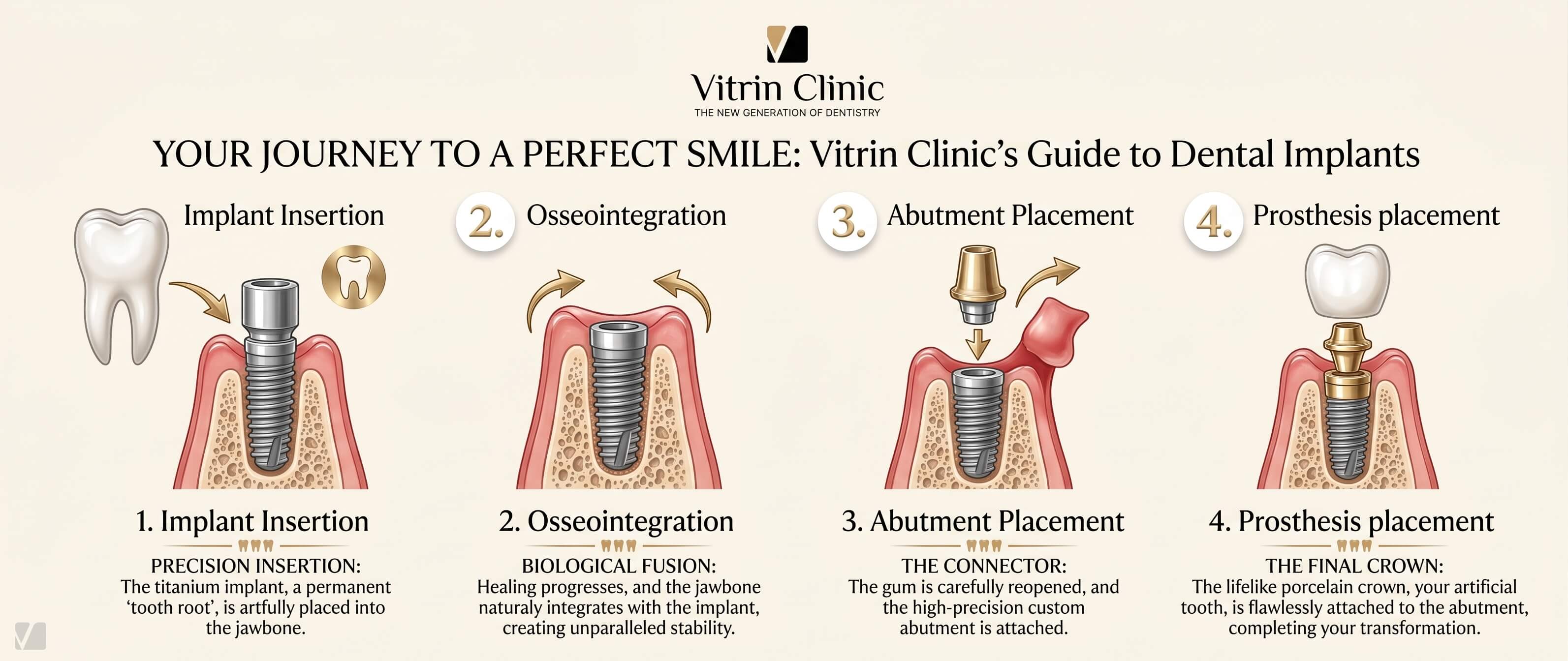 Step by Step Endosteal Implant Procedure